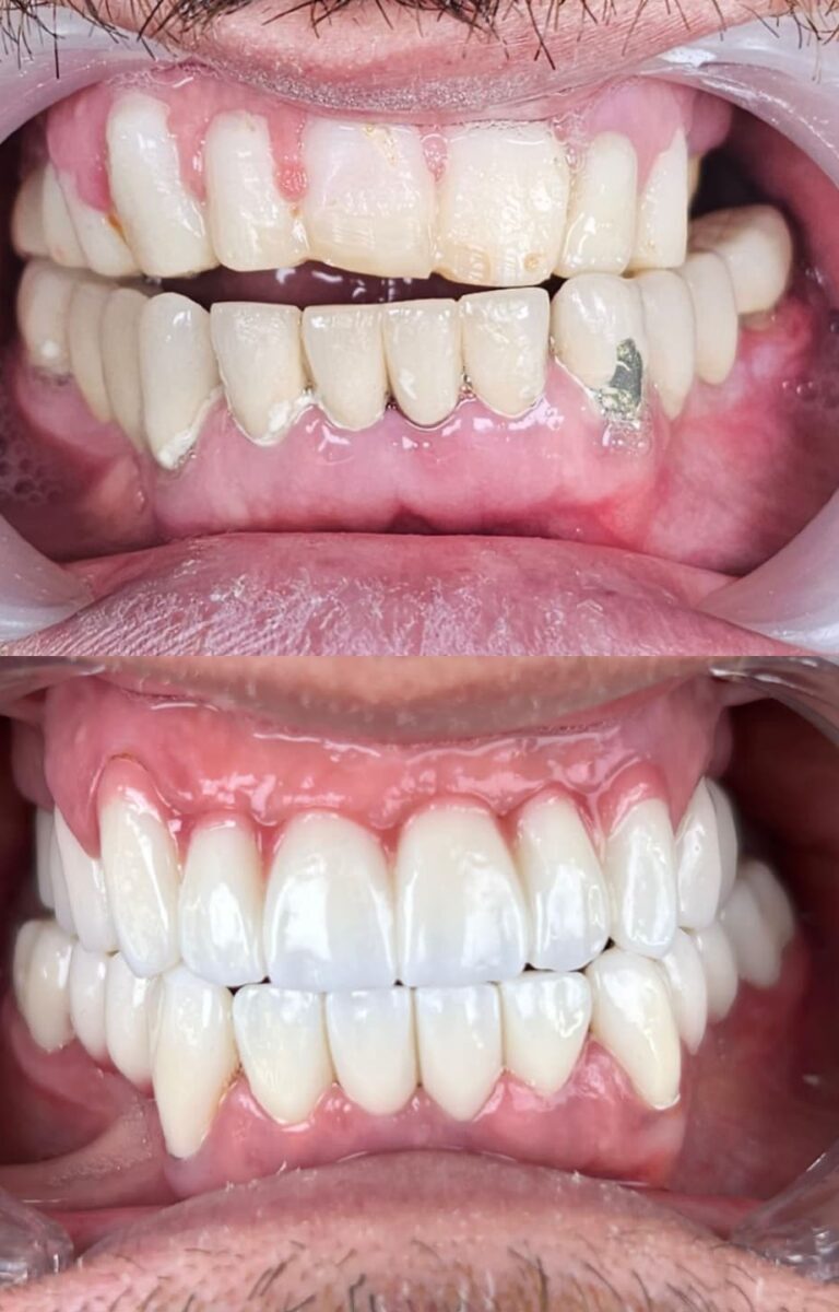 ba1