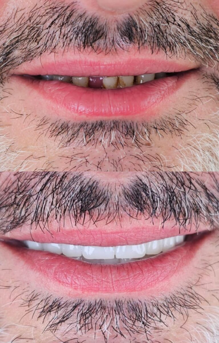 ba4