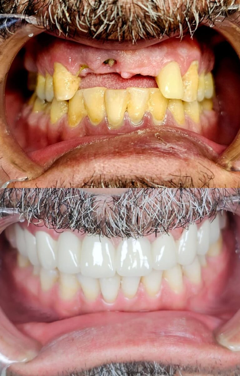 ba5