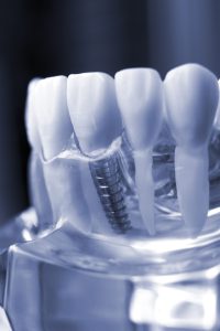 subperiostal implant