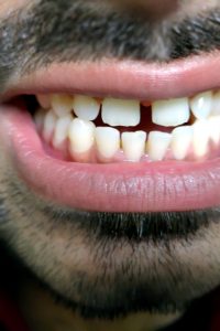 diastema